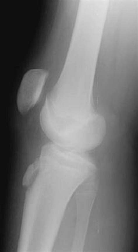 Tibial Tubercle Fracture