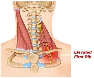 Broken ribs are most commonly caused by direct impacts — such as those from motor vehicle accidents, falls, child abuse or contact sports. Elevated first rib is an underappreciated cause of neck ...