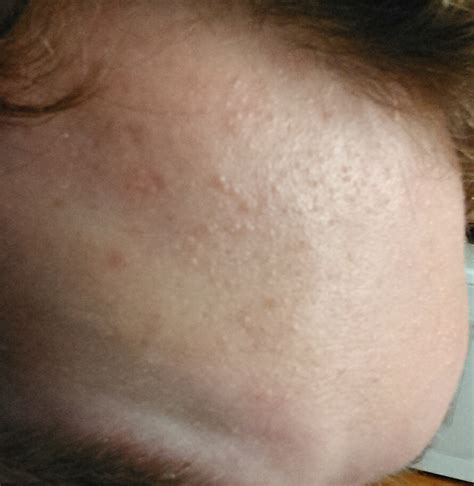 Colorless Bumps All Over Forehead And Cheeks General Acne Discussion