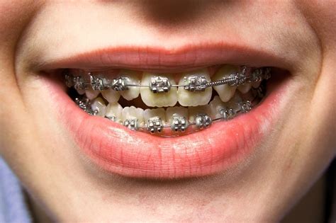 How Much Does It Cost To Get Dental Braces And Invisalign In Singapore?