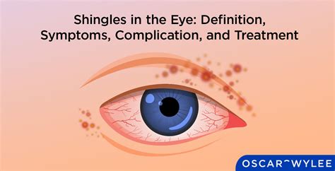 Shingles In The Eye Symptoms Complications And More