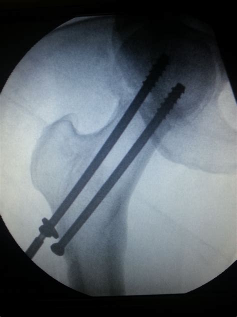 Neck Of Femur Fracture Surgery Wikidoc