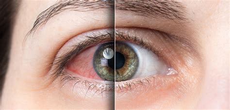 síndrome del ojo seco oftalmólogos martinez de carneros madrid