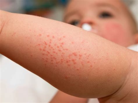 How To Effectively Treat An Infants Heat Rashes Babystufflab