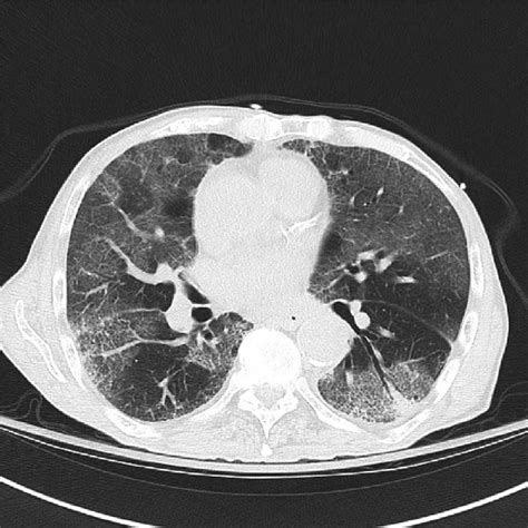 Ct Scan Of Chest Showing Bilateral Diffuse Ground Glass Opacity Of Lung