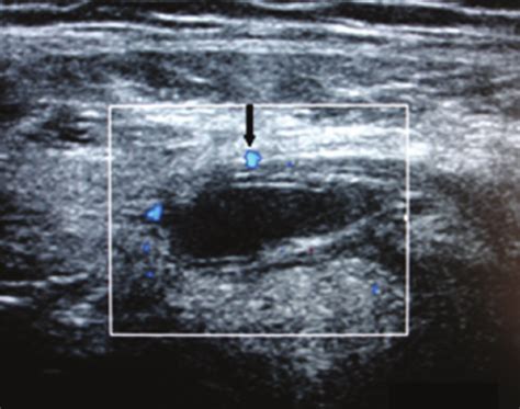 Ultrasound Scan Showing Hypoechoic Lesion Lateral To The Rectus