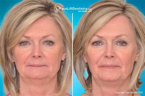 We did not find results for: Overbite Fix, No Braces, No Aligners, No Surgery, 8-Days