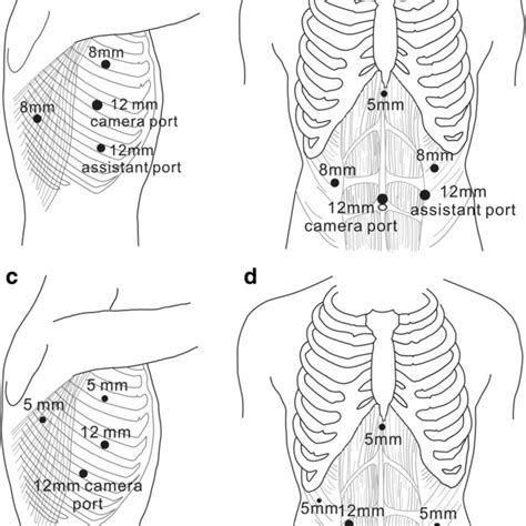 Trocar Placement For Thoracic Part A And Abdominal Part B Of