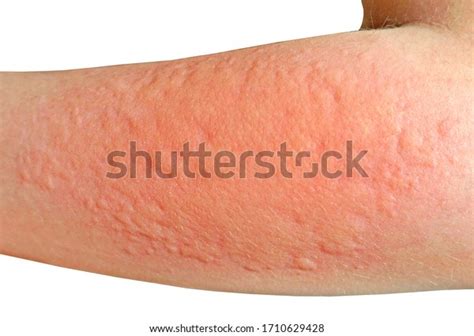Skin Rashes Allergies Contact Dermatitis Allergic Stock Photo
