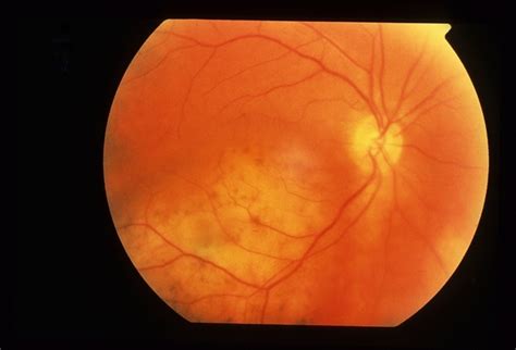 Amelanotic Malignant Melanoma Retina Image Bank