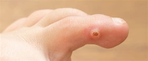 plantar warts treatment portsmouth and nashua nh northeast foot and ankle