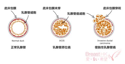 乳房原位癌 Breast Cancer Hk 香港的乳癌治療資訊