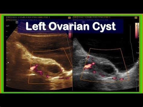 Practical Ultrasonography Left Ovarian Cyst Ovarian Cyst Ovarian Cysts