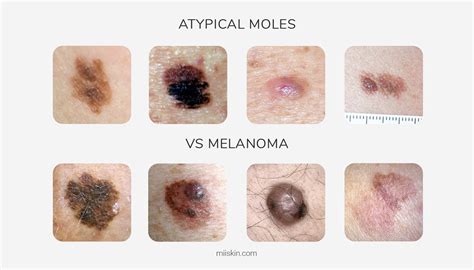 Cancerous Moles Vs Normal Moles