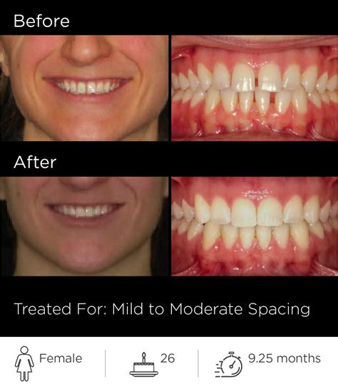 Before and After Gallery - Suresmile USA