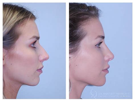 Rhinoplasty Cosmetic Surgery Vancouver BC