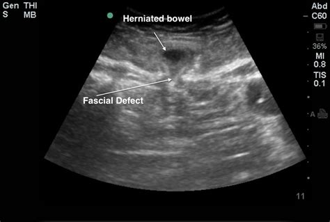 Left Lower Quadrant Hernia Ovulation Symptoms