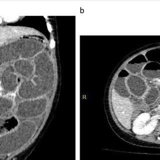 Contrast Enhanced Computed Tomography Images Of Case A Cystic Mass