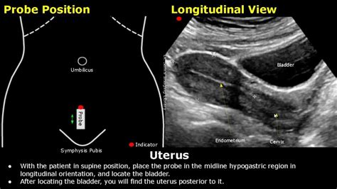 Uterus And Ovaries Ultrasound Probe Positioning Transducer Placement