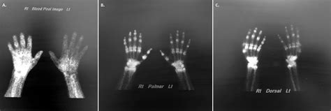 Cureus Reflex Sympathetic Dystrophy Of The Right Hand Following An