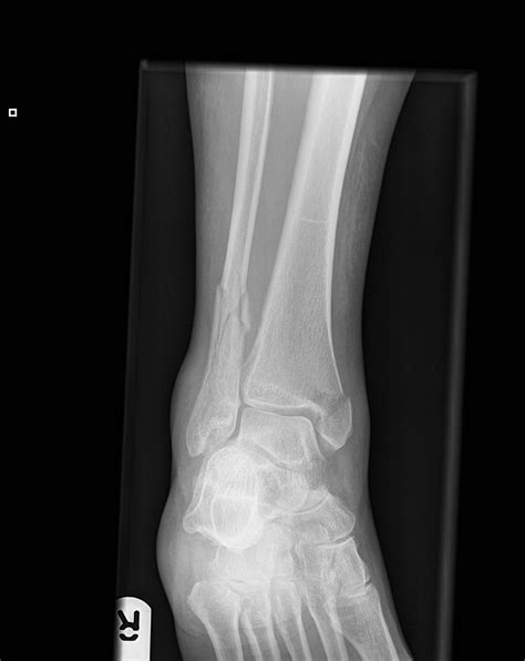 Distal Tibia And Fibula Fracture Image