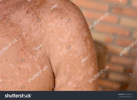 Tinea Versicolorpityriasis Versicolor On Skin Foto Stock The Best