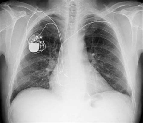 What are the risks of pacemaker surgery? Pacemaker WARNING as everyday appliances can DISRUPT ...