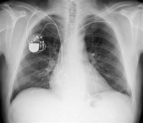 37.71 initial insertion of transvenous lead (electrode) into ventricle 02hk3jz insertion of pacemaker lead into right ventricle, percutaneous approach 37.72 initial insertion of transvenous leads (electrodes). Pacemaker WARNING as everyday appliances can DISRUPT ...