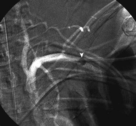 Inadvertent Subclavian Arteriotomy Closure Using The Mynx Vascular