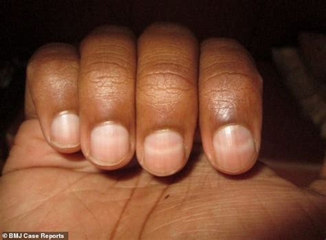 Man Gets White Stripes Across His Fingernails After Climbing A 7000m