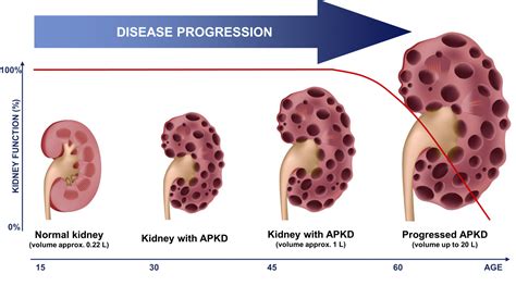 Study Shows Polycystic Kidney Disease Can Be Treated By Ketogenic Diet