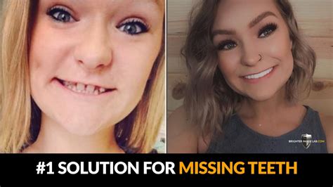 New Missing Teeth Solution Complete Smile Transformations W Dental Veneers Youtube