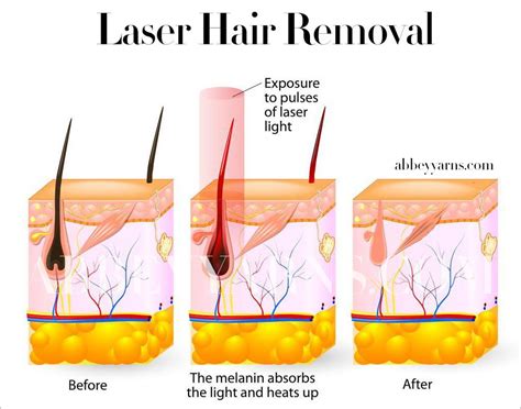 Electrolysis Vs Laser Hair Removal The Complete Guide 10 Laser Hair