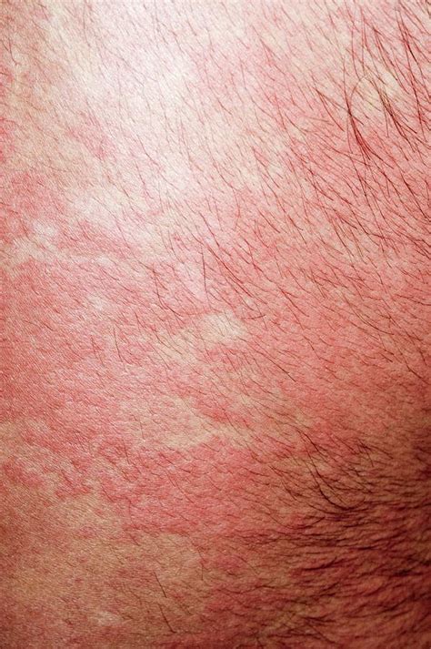 Urticaria Rash On The Back Photograph By Dr P Marazziscience Photo