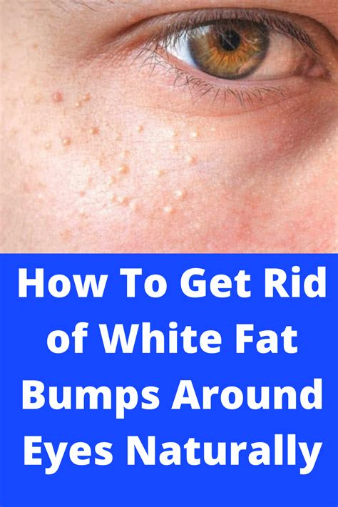How To Get Rid Of White Fat Bumps Around Eyes Naturally By Good