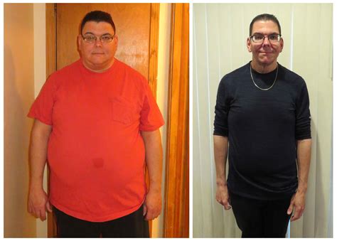 Marcus Drops 140 Pounds in 12 Months after Gastric Sleeve — Prime Surgicare