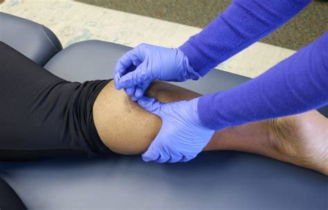 Trigger Point Dry Needling True North Physical Therapy