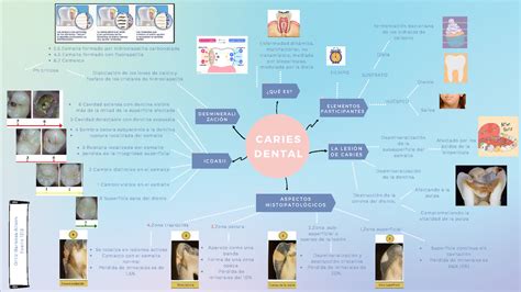 Caries Dental Mapa Conceptual Demi Mapa Images And Photos Finder