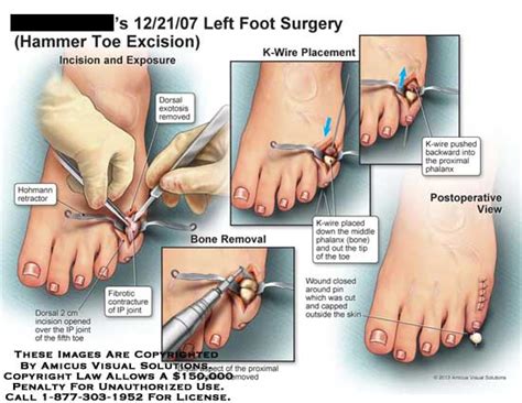 Foot Surgery Hammer Toe Excision