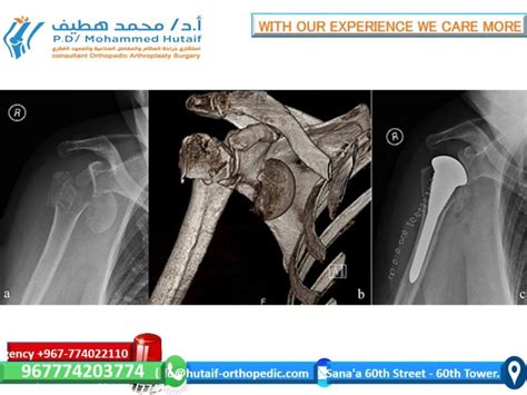For Doctors Proximal Humeral Fractures Extra Articular 2 Part