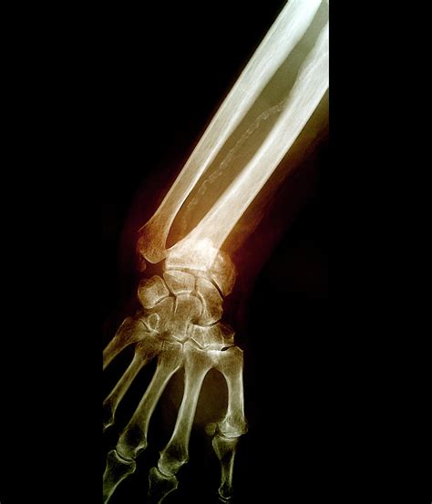 Colles Wrist Fracture Photograph By Zephyrscience Photo Library