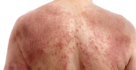 Eczema Atopic Dermatitis Treament Specialists In Coral Springs Fl