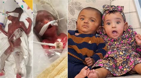 world s most premature twins guinness record ontario twins defy odds to celebrate 1st birthday