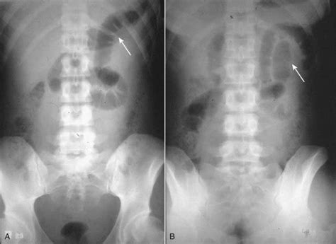 Recognizing Bowel Obstruction And Ileus Radiology Key