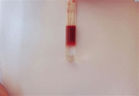 2 Diluted Blood Overlaid On Ficoll Paque Before Gradient