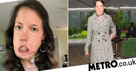 woman with disfigurement that stops her smiling becomes catwalk model metro news