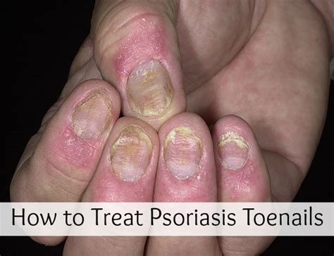 How To Treat Psoriasis Toenails Medi Craze Homeopathic Pinterest
