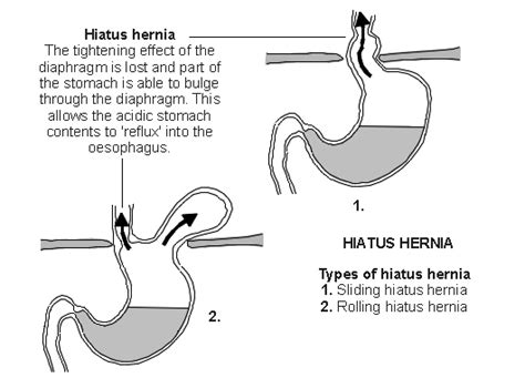 Diagram Of Hiatal Hernia