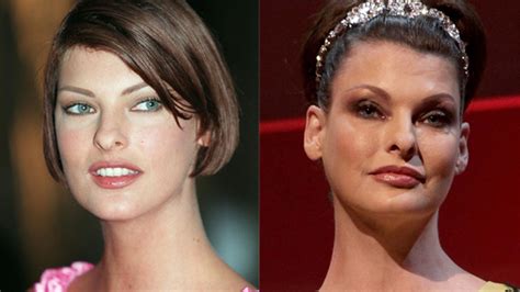 Linda Evangelista Son Effrayant Avantaprès Chirurgie Esthétique