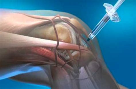 stem cell injection alternative to knee replacement